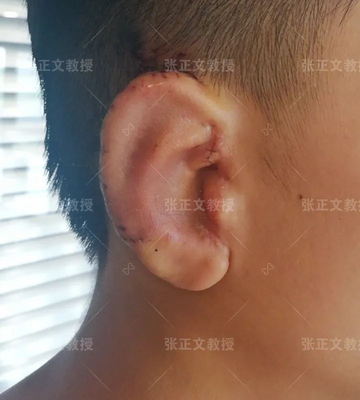 再造的耳朵多久可以长好