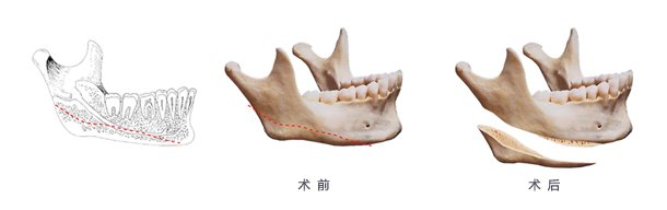 颌面手术后多长时间能看到效果