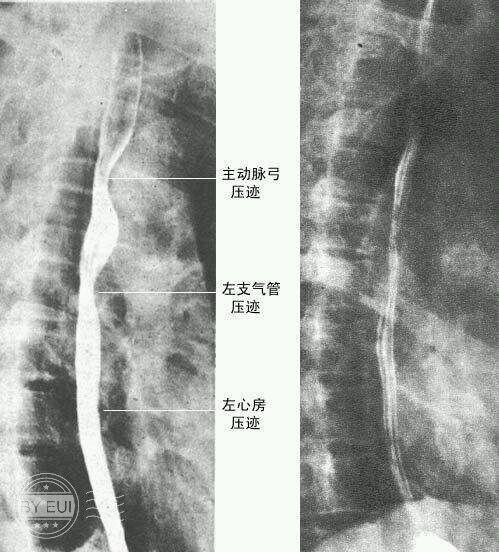 食管癌预警