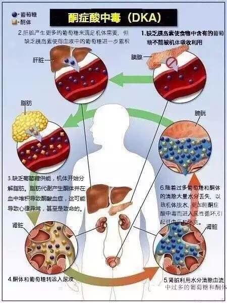 尿中有酮体就是酮症酸中毒吗?