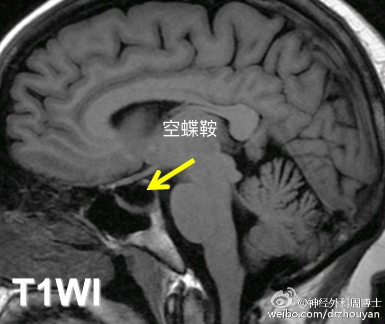 【临床病例分析】鞍区rathke囊肿的诊断及治疗方案