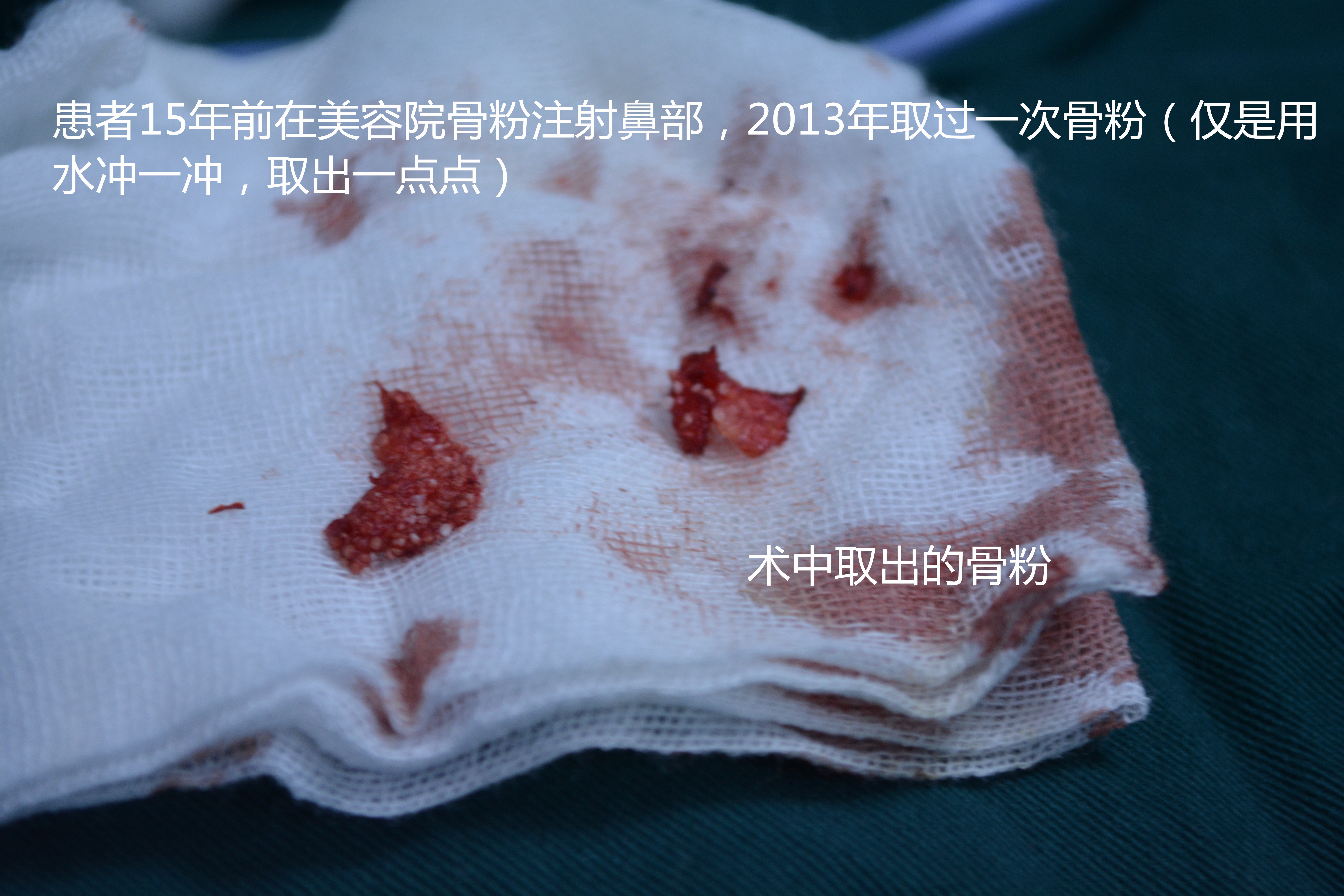 注射骨粉10年,取出后竟成这样?