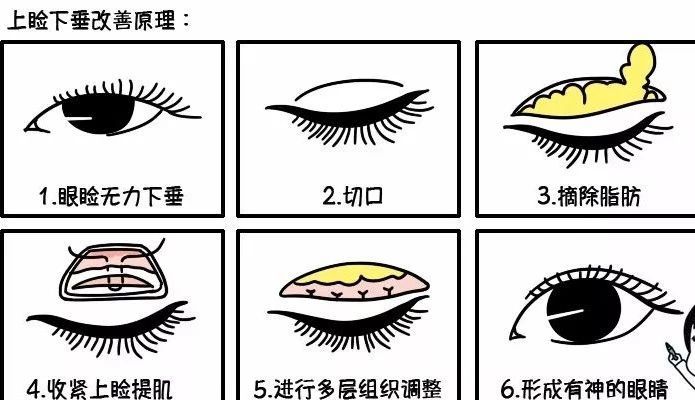 上睑提肌缩短术图片_纵览新闻
