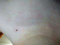 皮肤表面有个很小的东西,是黑的,硬的。我是突