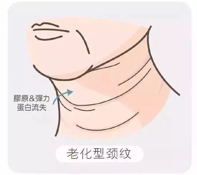 有干货 颈纹真的很显老,解决它有小妙招!