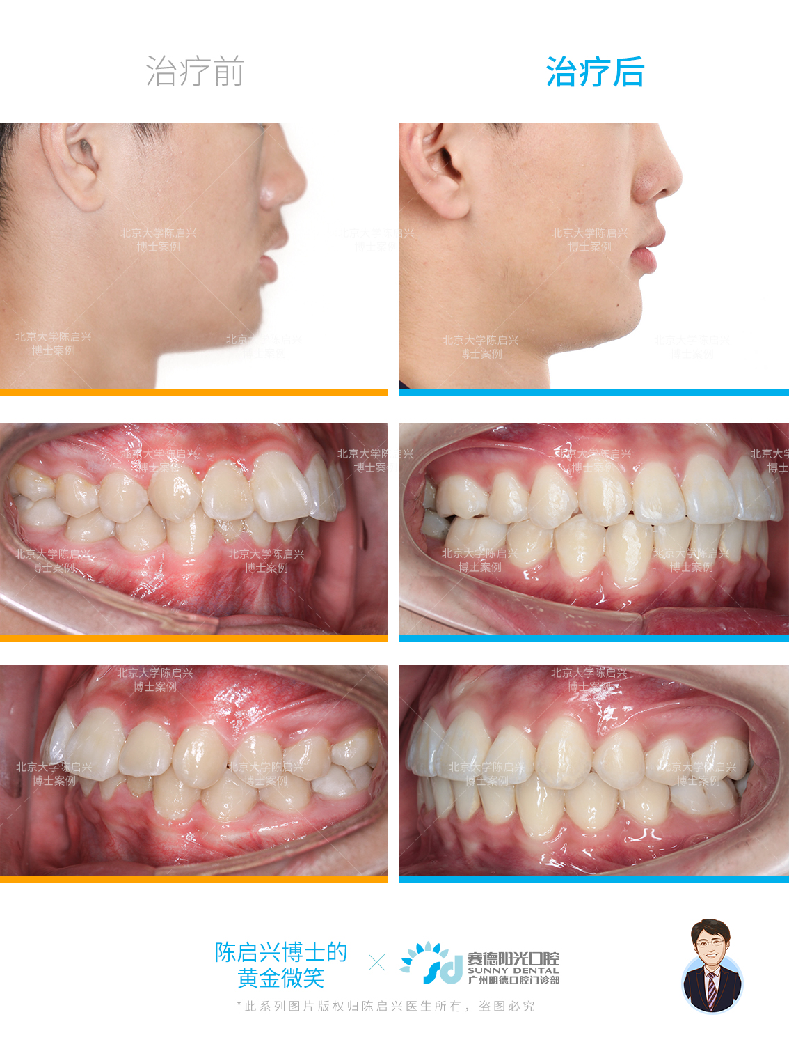 替牙期牙槽突裂患者行块状髂骨植骨术的初步疗效分析