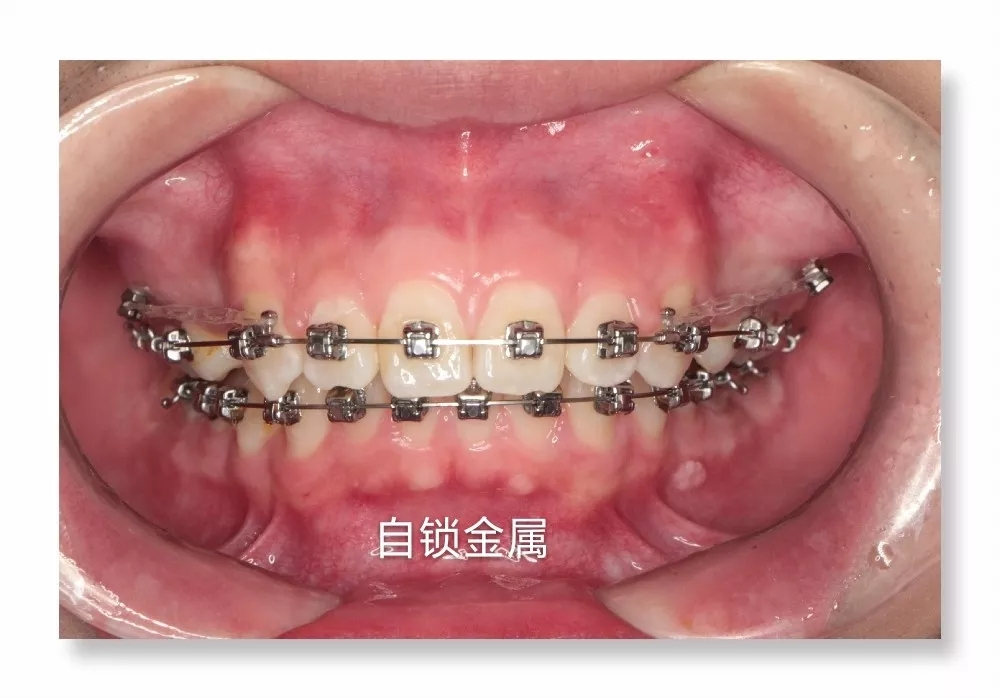 发展历史最久,技术相对最成熟,又分普通金属和自锁金属牙套两种