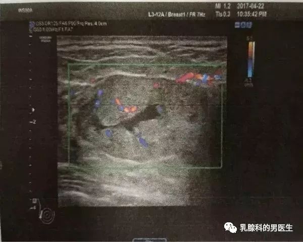 解读哺乳期乳腺超声——新年第一天,乳腺科的男医生又来吓人了!