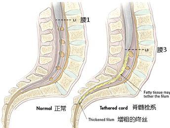 脊髓栓系综合征患者常见的症状表现有腰骶部皮肤改变(皮肤隆突或凹陷