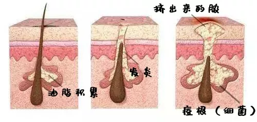 脖子上的痘痘反复长,是因为淋巴出问题了吗?