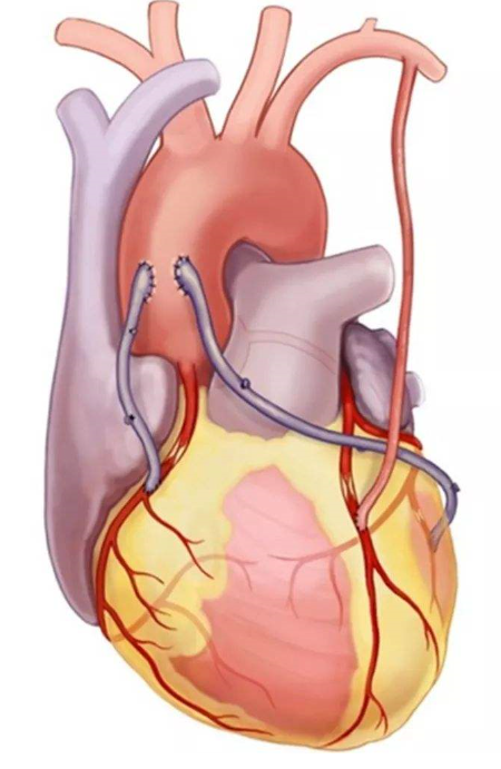 一般的,我们取左侧胸廓内动脉(lima)搭在前降支血管(这是主流血管)上