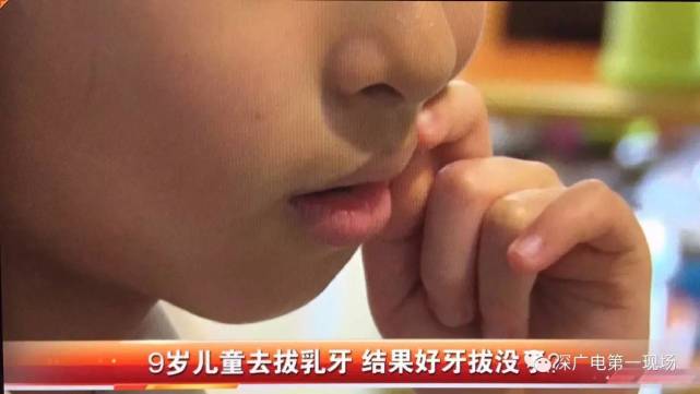 深圳9岁女童被拔错牙院方所拔除乳牙具备拔除指征