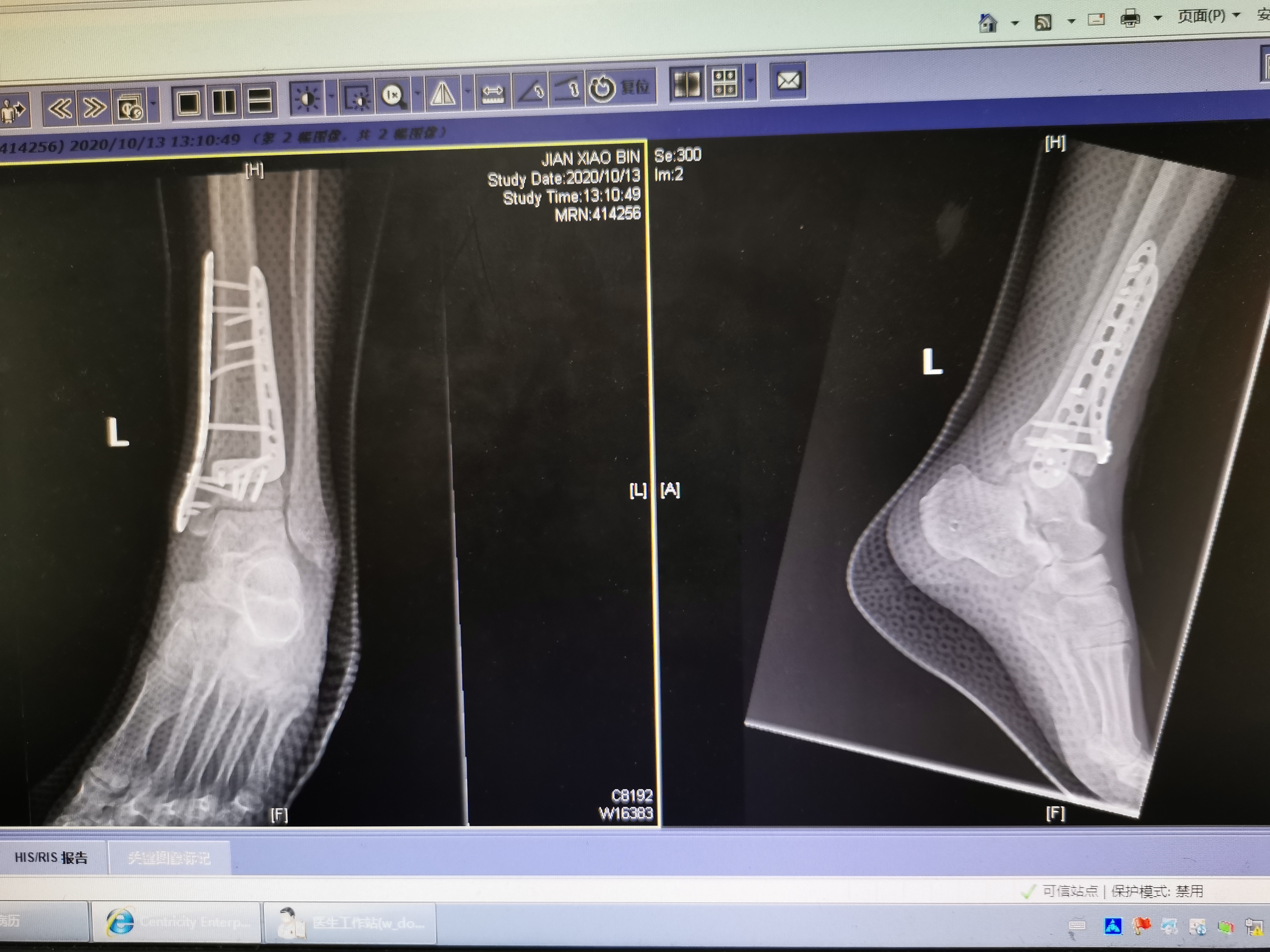 踝关节周围骨折手术治疗pilon骨折