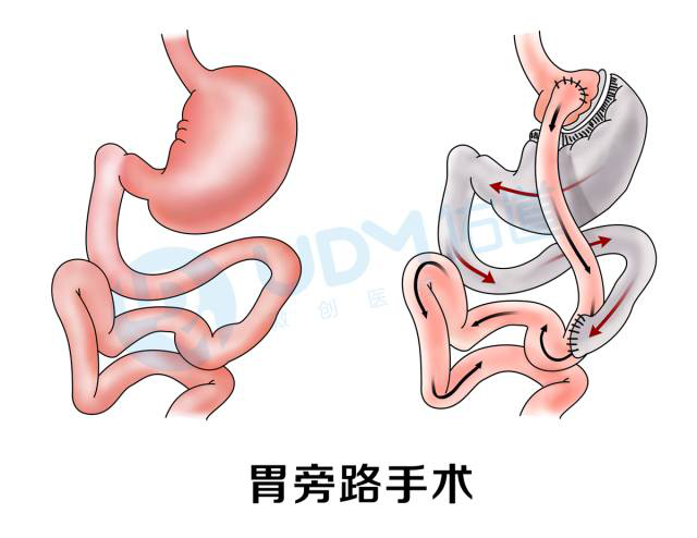 关于胃旁路手术你了解多少