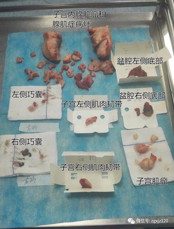 北京人,患子宫腺肌症5年,如今康复,