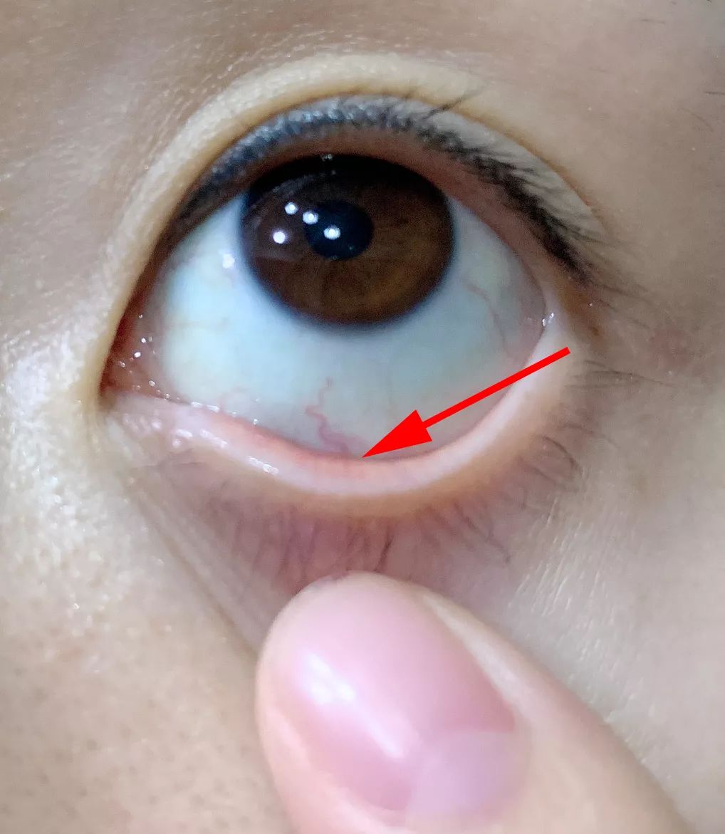 而是 滴在眼球和"下眼皮"之间的结膜囊内 如果直接滴在黑眼珠上会