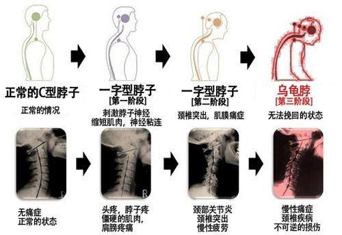 9成颈椎病在家就可以施展的调治方法!