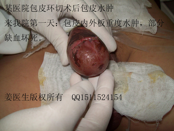 qq1511524154 东莞市东华医院泌尿外科姜华龙 包皮环切"小手术"