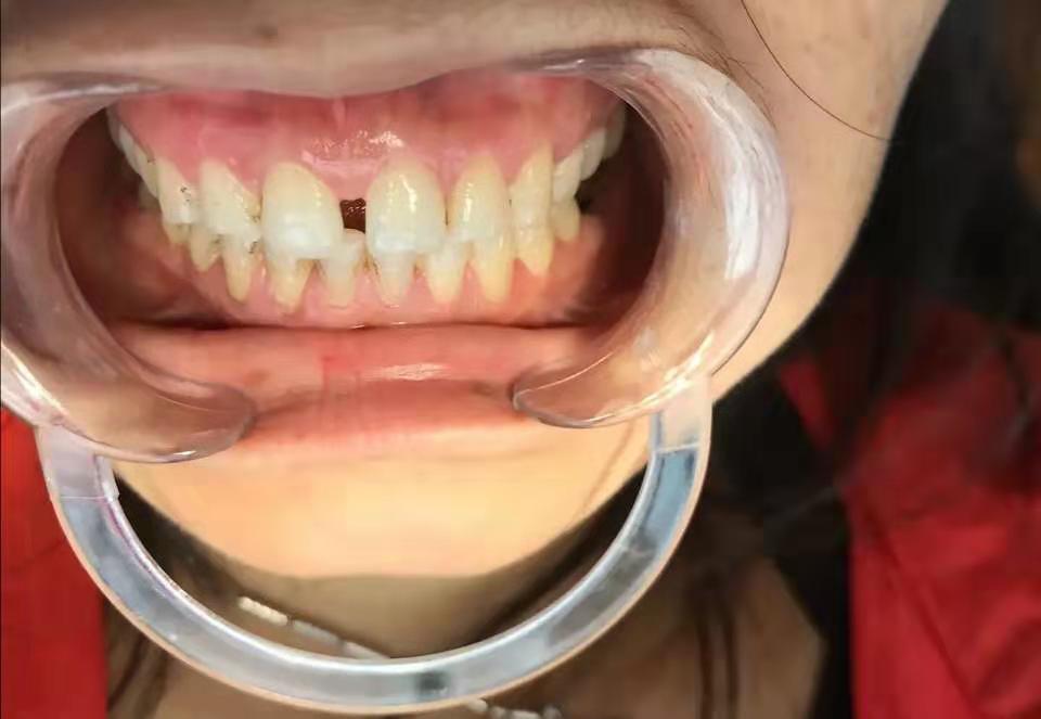 这个门牙有缝隙的治疗方法有好几种:1,矫正牙齿.2,补牙.3,烤瓷牙.