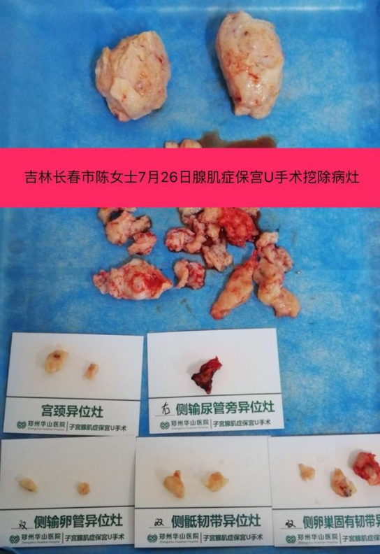 芳华岁月,18岁遇上子宫腺肌症,患病整整14年