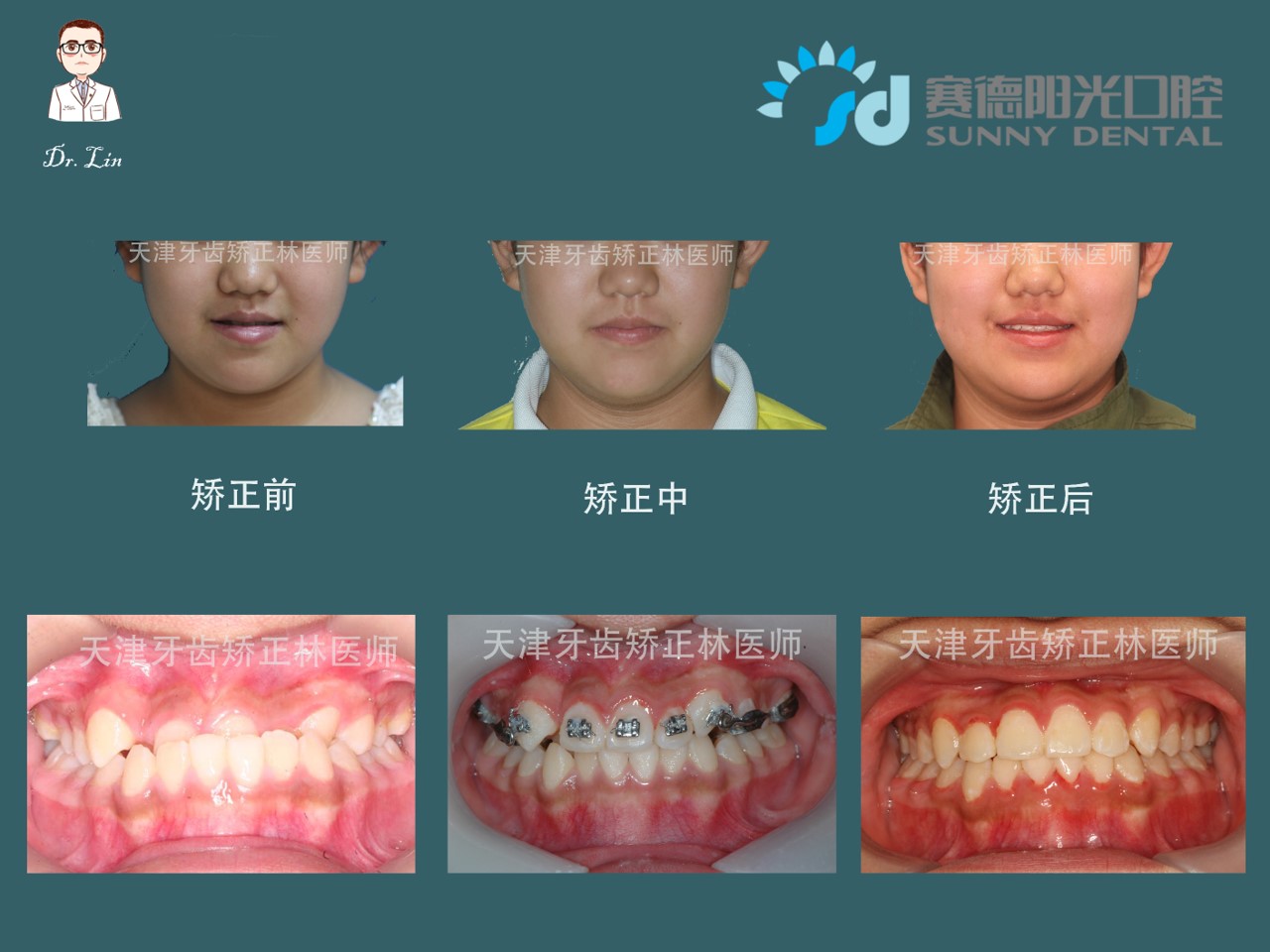 有生长潜力的兜齿儿童需要双期治疗