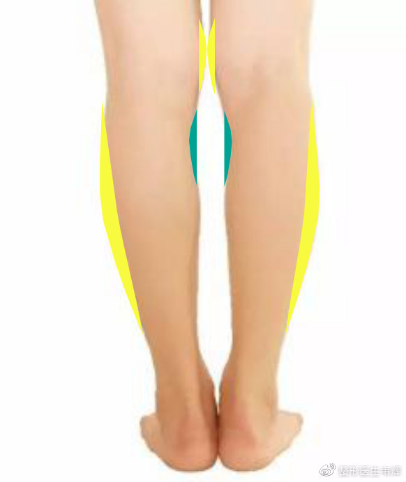 采取外吸内补膝内吸脂纠正o型腿外观恢复小腿纤细直挺