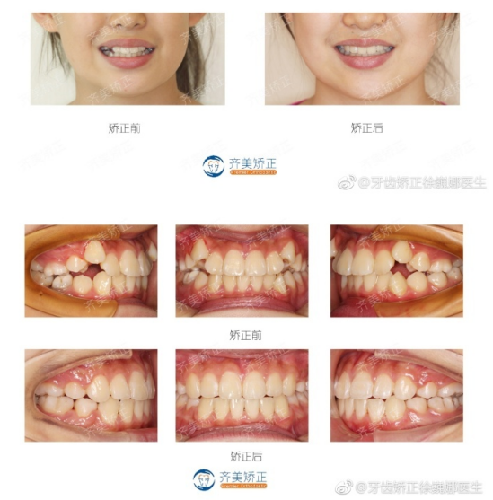 或将其磨小,然后利用正畸手段将虎牙迁移到正常位置上,较拔除虎牙的