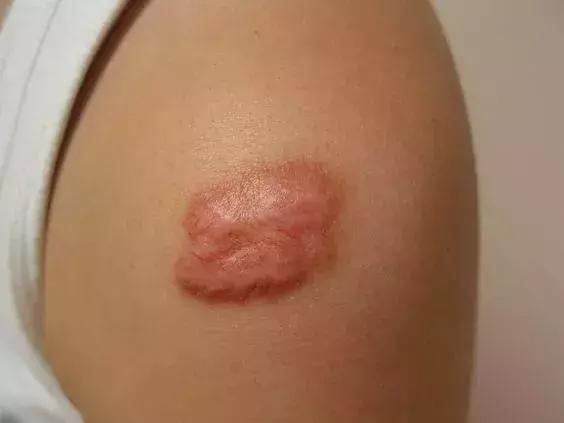 这类疤痕与凹洞型疤痕正好相反,是一种过度肥厚的疤痕,在长过痘痘的
