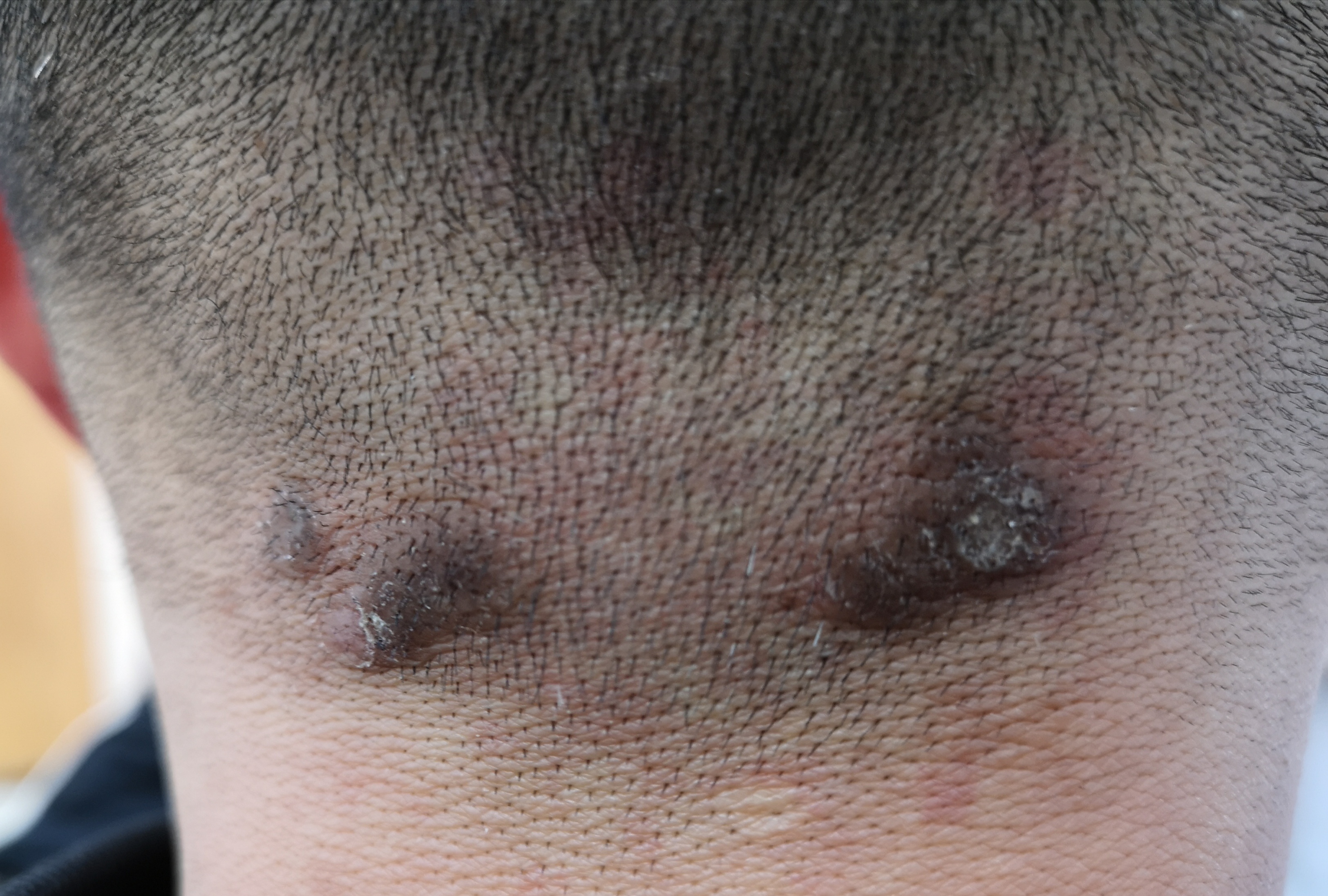 马拉色菌毛囊炎的治疗记录 - 知乎
