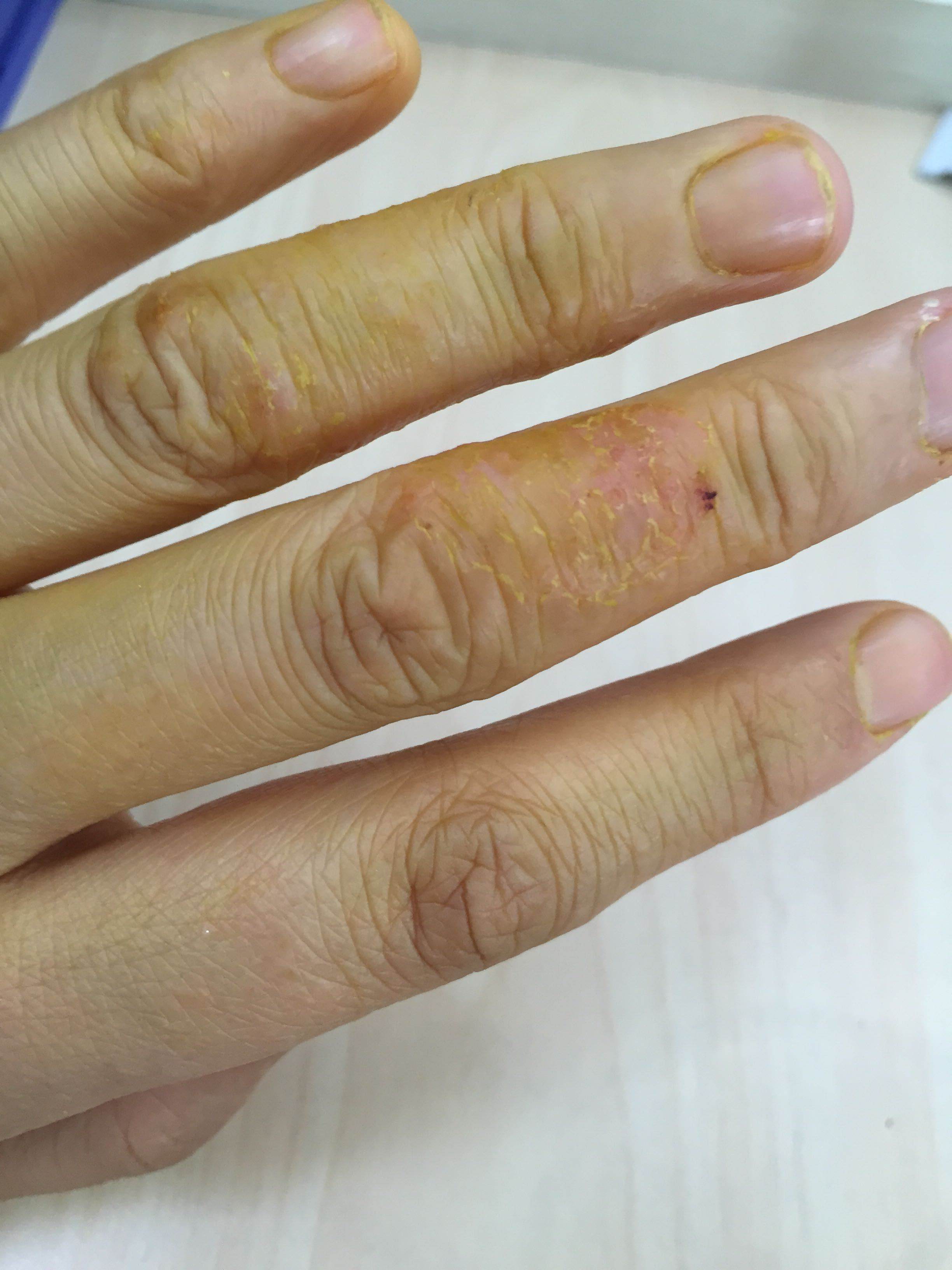 手指关节部位皮肤增厚,脱皮,是什么原因?