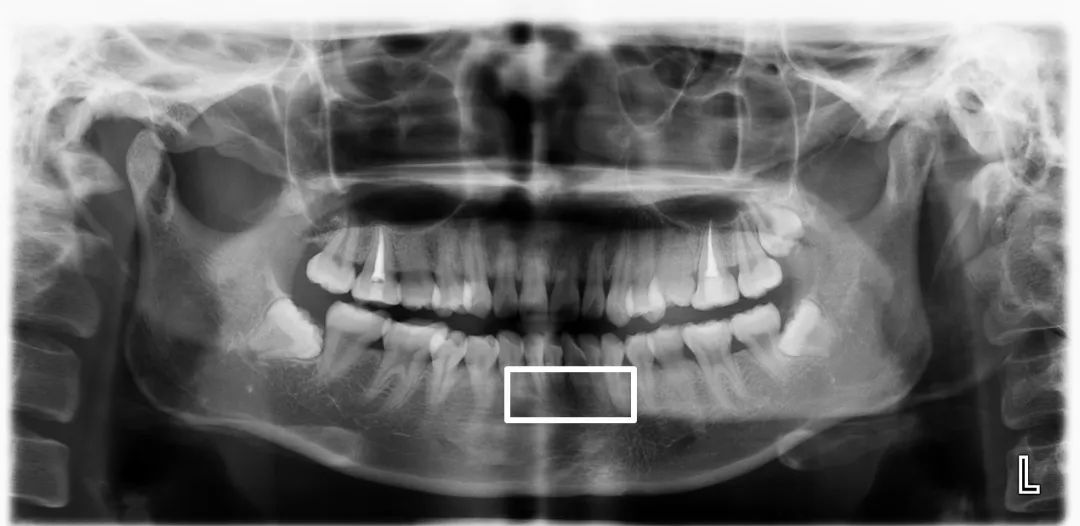 在一张图像上显示全口牙齿,牙周组织及颞下颌关节等情况的医学影像