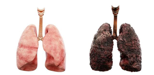 抽烟会让肺发黑,引起肺气肿,戒烟15年才能降低患癌率