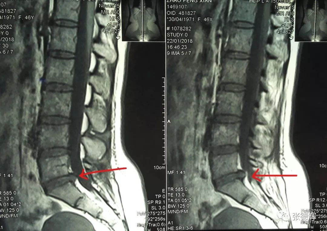 脊柱内镜——腰5骶1突出 椎板间入路(腋下)