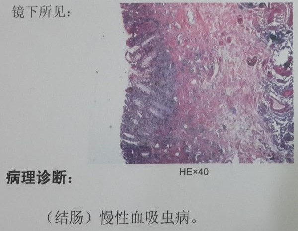 血吸虫结肠癌的一种常见原因