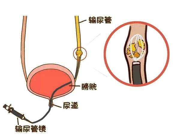 诊断血尿. 取出在输尿管内移位的输尿管导管.