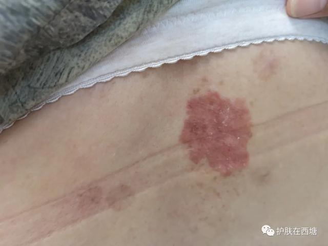 不痛不痒的一片红斑,居然是皮肤癌!