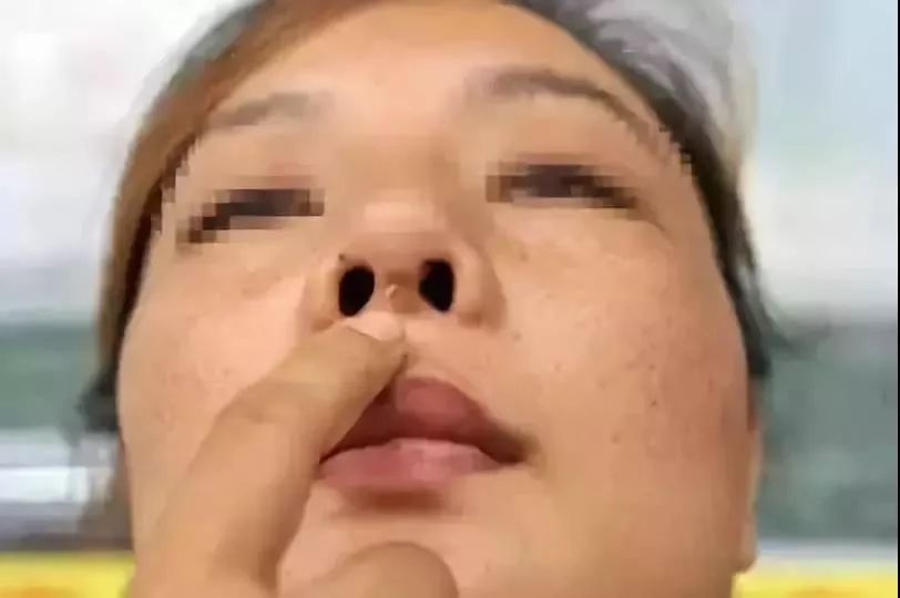 统计10月的鼻部手术数量来看 鼻修复的案例占去了50% 其中有部分都是网红鼻的修复手术 风靡一时的网红鼻 怎么突然就过时了呢? 今天跟大家好好聊聊网红鼻! 为什么网红鼻早晚要修复? 要知道,鼻子的加高加长必须有一定的限度,无论使用任何一种材料,都是在皮肤软组织深部放进去了一个体积不增加的扩张器,就像一个气球,使劲吹,不停吹,过了限度,总会爆掉的!