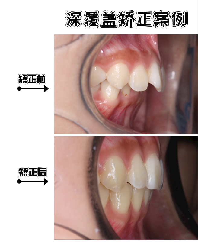 1,前牙深覆盖的患者一般伴有上牙唇倾的情况,有时还伴有牙列拥挤问题