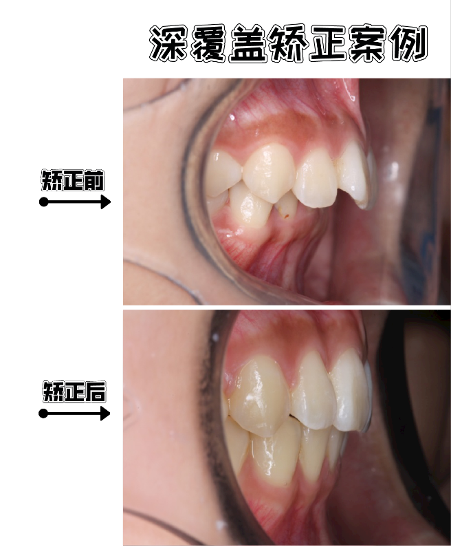 2,如果是严重骨性的深覆盖,则可能要配合口腔外科手术才能达到理想的