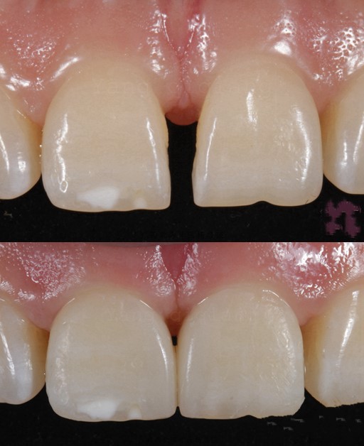 牙周炎患者的牙龈状况,牙与牙之间有大大的缝隙,牙龈红肿退缩,暴露出