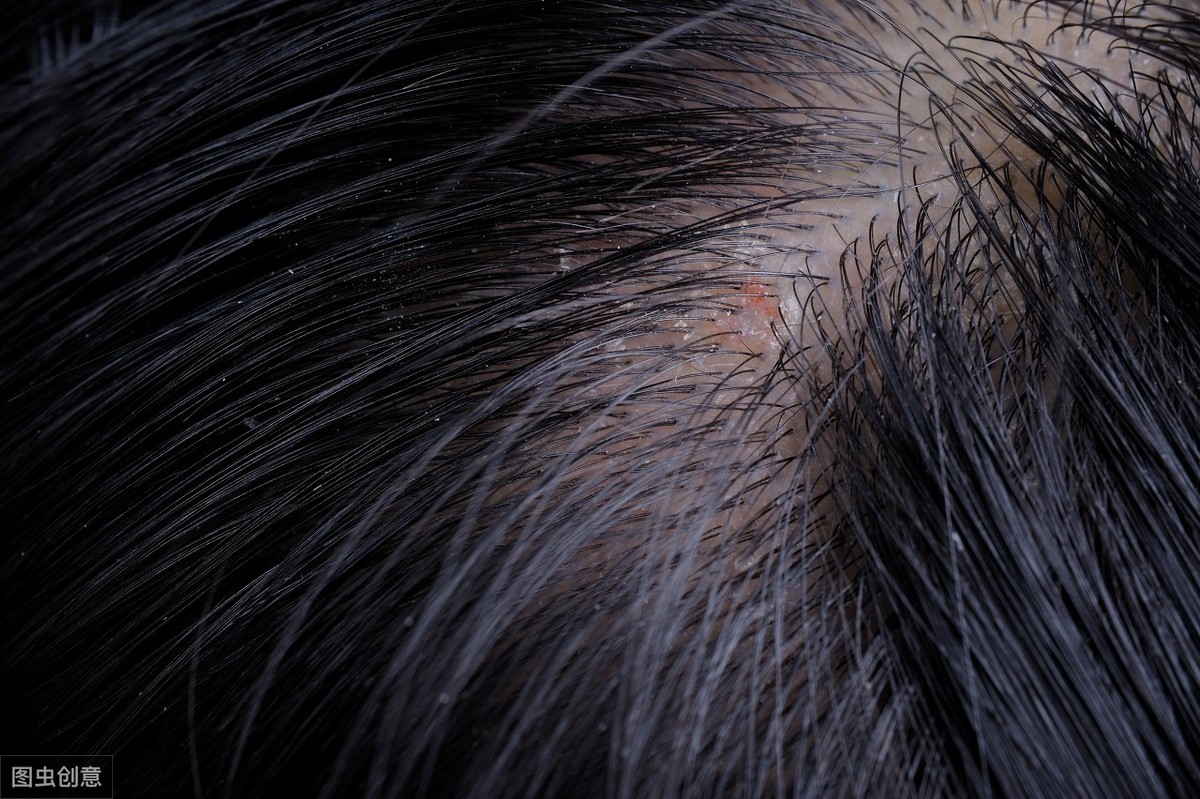 头皮瘙痒可能是真菌感染,但和环境,气候变化,精神,烫染发或洗发产品或