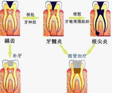 牙髓炎和牙周炎的区别是什么?