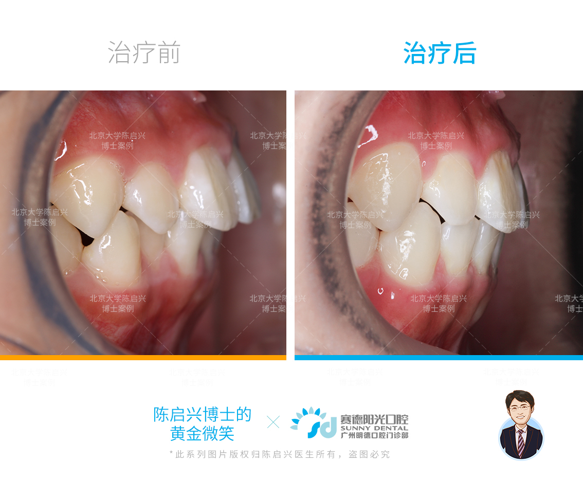 青少年嘴突腺样体面容矫正案例