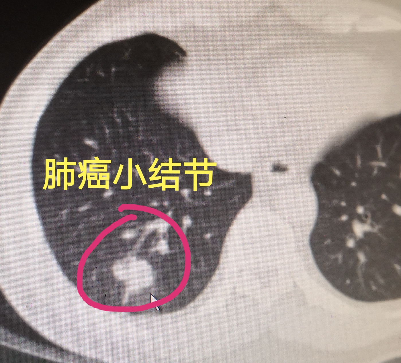 得了肺癌,不治疗,可以吗?