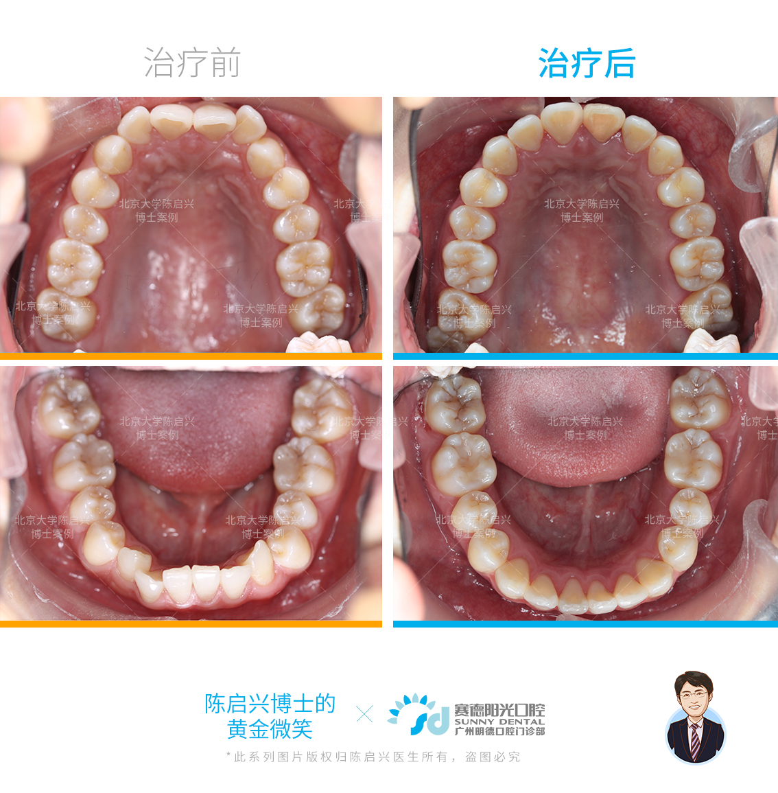 不拔牙矫正改善严重深覆合开唇露齿