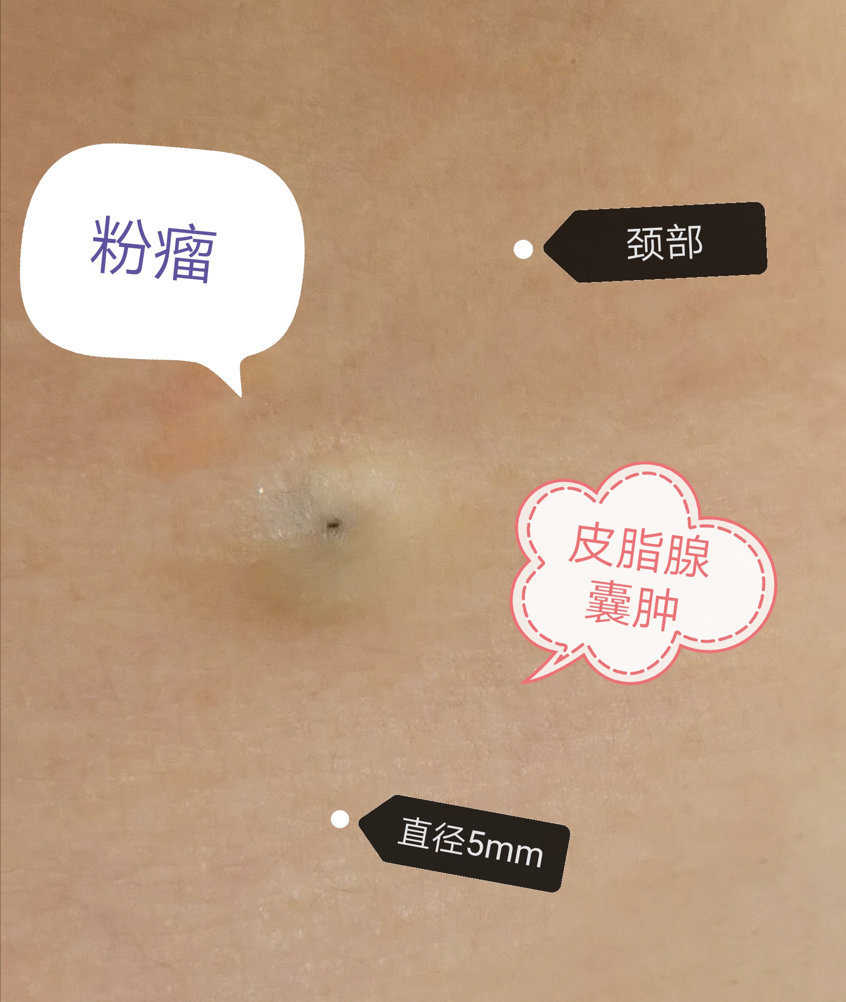 外阴囊肿是什么原因造成的-中国医药信息查询平台