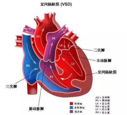 专家答疑:看了您的彩超报告,您主要是一个膜周部室间隔缺损3mm.