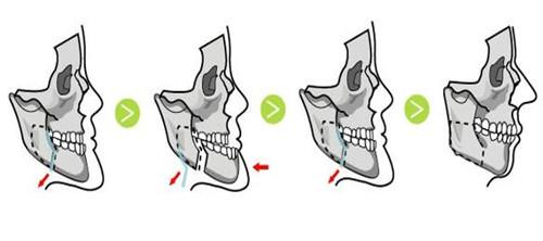 口腔结构问题首先会导致位于牙齿周围的上下颌骨出现生长异常,可能会