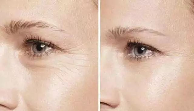 根据眉所需要降低的程度及上睑皮肤松弛程度,设计切口及去除多余皮肤