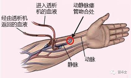 造个动静脉内瘘不容易岂能让它轻易受伤害